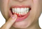 Sorriso em risco? Os efeitos silenciosos do Mounjaro nos dentes que você precisa conhecer
